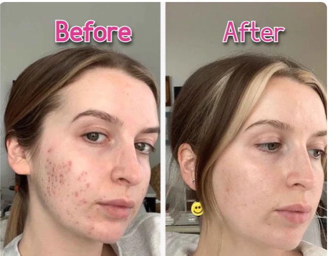 LED Face & Neck Anti-Wrinkle Massager